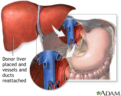 Donor liver attachment