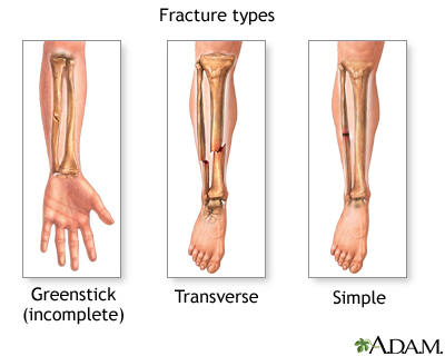 Fracture types (2)