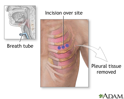 Incision for pleural tissue biopsy