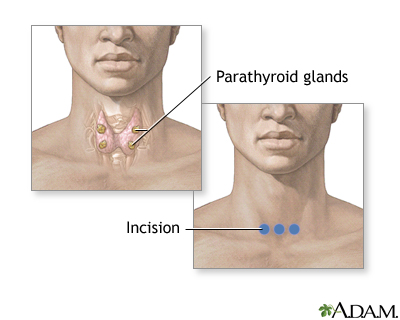 Parathyroid biopsy