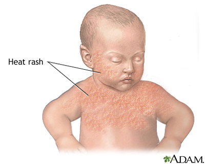 Infant heat rash