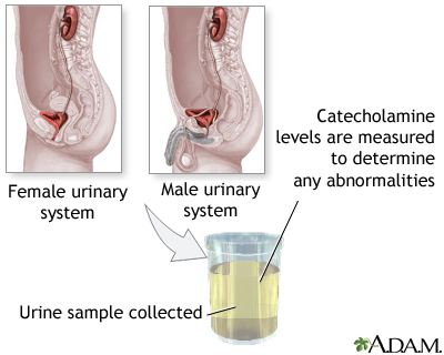 Catecholamine urine test
