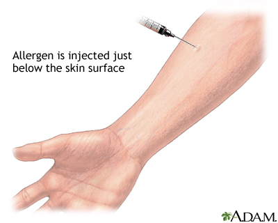 Aspergillus antigen skin test