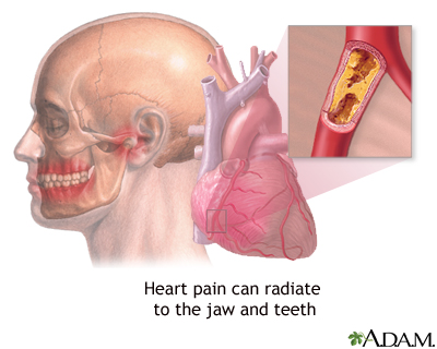 Jaw pain and heart attacks