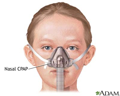 Nasal CPAP