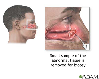 Nasal biopsy