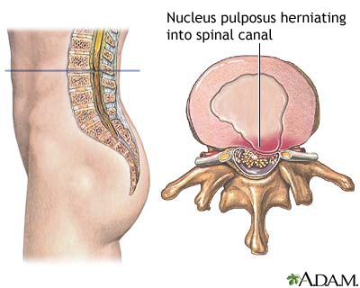 Herniated nucleus pulposis