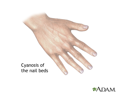 Cyanosis of the nail bed