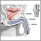 Transurethral Resection of the Prostate (TURP) - Series