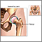 Hip joint replacement - Series