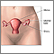 Hysterectomy - Series
