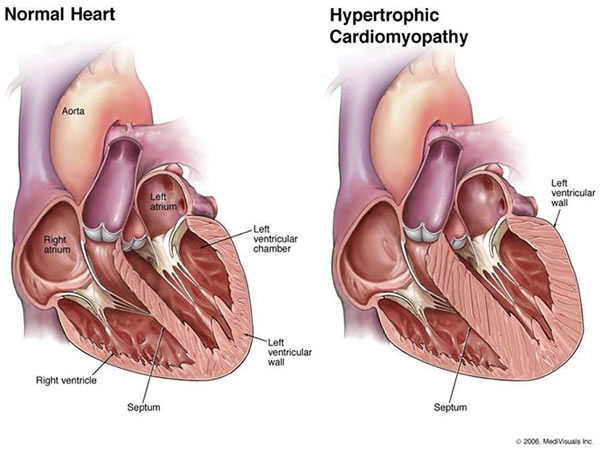Illustrations of a normal heart and a heart with hypertrophic cardiomyopathy.