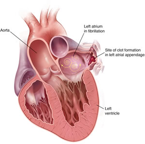 More than 90% of stroke-causing clots that come from the heart are formed in the LAA.